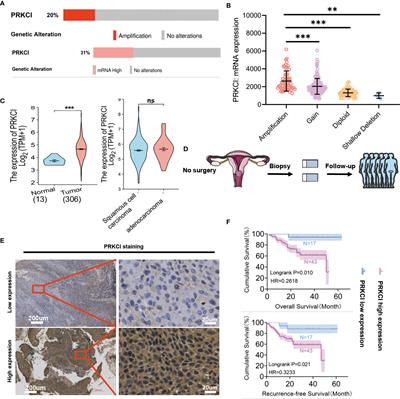 PRKCI Mediates Radiosensitivity via the Hedgehog/GLI1 Pathway in Cervical Cancer